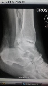 ImagingTechnologyNews December-2015 X-ray_Fractured_fibula_with_permission_of_patient_MF