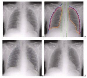 Carestream Bone Suppression Software