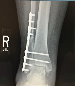 ITN NEWS Orthopedic_Surgery_repair_of_Broken_fibula_with_permission_of_patient_MF_0