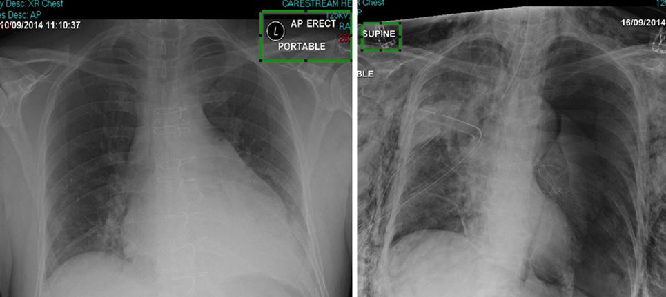 A Guide To Mobile Chest X Rays For Thoracic And Cardiac Care Everything Rad