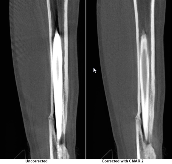 comparison of radius fracture with and without CMAR2 correction