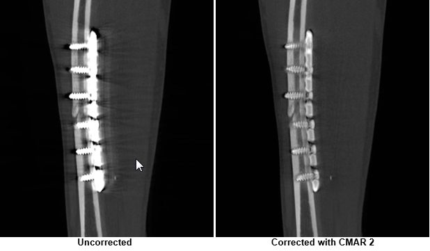 comparison of 2 images of a tibial shaft fracture with and without CMAR2 correction