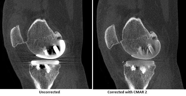 comparison of 2 images of sagittal plane through knee, with and without CMAR 2 correction