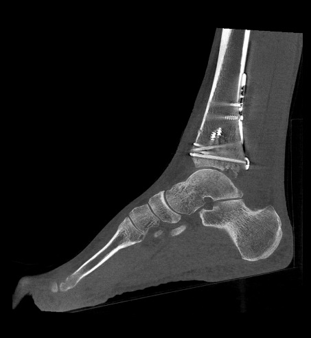 Image of foot. 