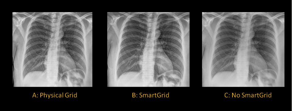 series of 3 chest x-ray images