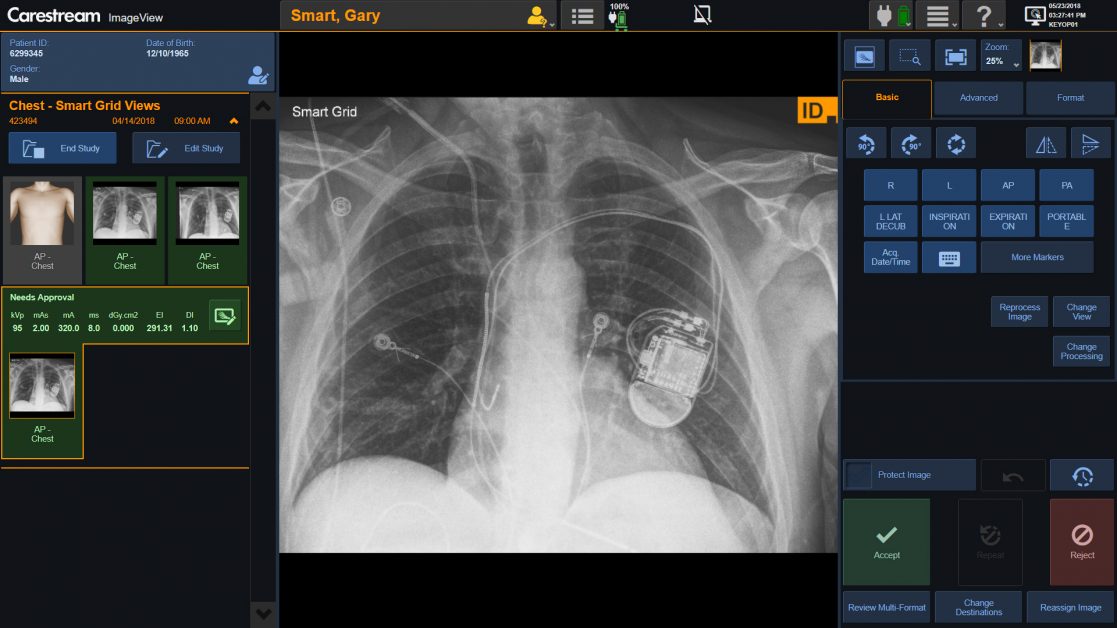 Exemplo de software ImageView com raio X do tórax
