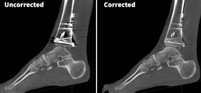 comparison of uncorrected and corrected x-ray images for metal artifact suppression 