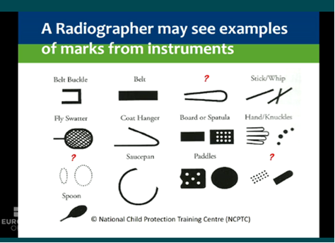 examples of marks from instruments a radiographer may see - belt buckle, belt, looped cord, stick/whip, fly swatter, coat hanger, board or spatula, hand/knuckles, bite marks, saucepan, paddles, hairbrush, spoon 