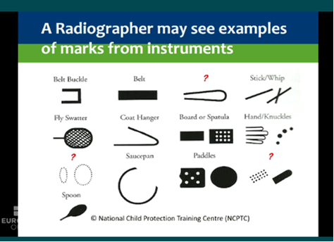 examples of marks from instruments a radiographer may see - belt buckle, belt, looped cord, stick/whip, fly swatter, coat hanger, board or spatula, hand/knuckles, bite marks, saucepan, paddles, hairbrush, spoon