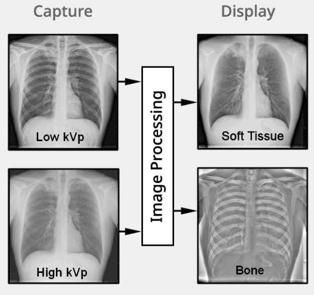 Imagen de radiografías de tórax que muestran diferencias entre kVp bajo y alto en energía dual.