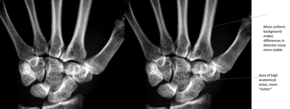 x-ray images of patient's hand showing differences between the two with the choice of scintillator or not. 