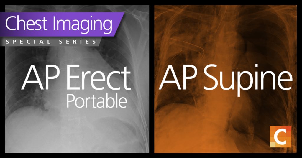 Duel photo. Left photo AP erect portable in black and white. Right photo AP supine with orange overlay. 