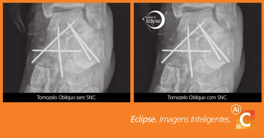 Comparação de imagens médicas de cotovelo tiradas com cancelamento de ruído inteligente e sem ele.