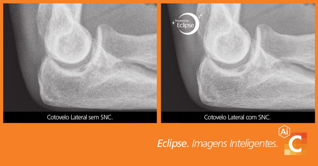 Comparação de imagens médicas de cotovelo tiradas com cancelamento de ruído inteligente e sem ele.