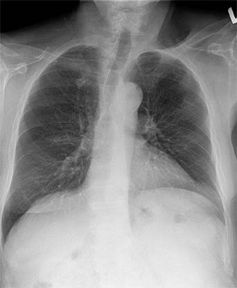 Radiografia toracica standard