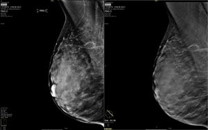 Digital 
Breast Tomosynthesis