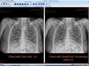 SmartGrid chest x-ray