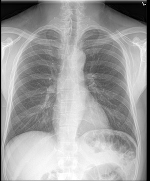 
			Radiografia toracica standard