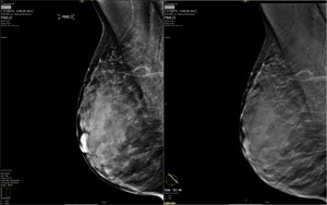 Digital Breast Tomosynthesis